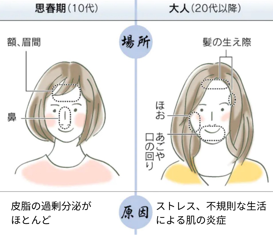 ニキビケアと美肌作りは同時に 憧れのツルツル肌 悩み続けたニキビ肌から卒業できた最強にきびケアとは マスクをつけるのが日常になった今 ニキビ肌に悩まされてる って方は多いと思います 最近 美容皮膚科医が薬用ニキビケア